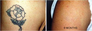 Tattoo Destroyer - Tattoo Removal Cream-2