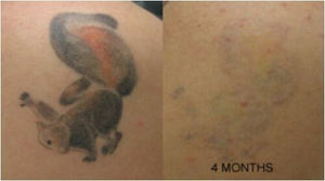 Tattoo Destroyer - Tattoo Removal Cream-1