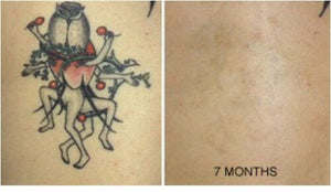 Tattoo Destroyer - Tattoo Removal Cream-3